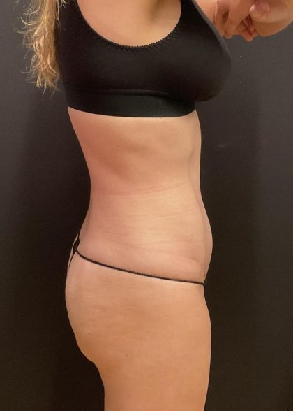 Liposuction Before & After Patient #6948