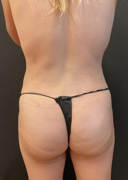 Liposuction Before & After Patient #6948