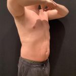 Liposuction Before & After Patient #6939