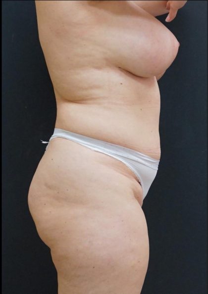 Liposuction Before & After Patient #6941