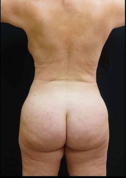 Liposuction Before & After Patient #6941