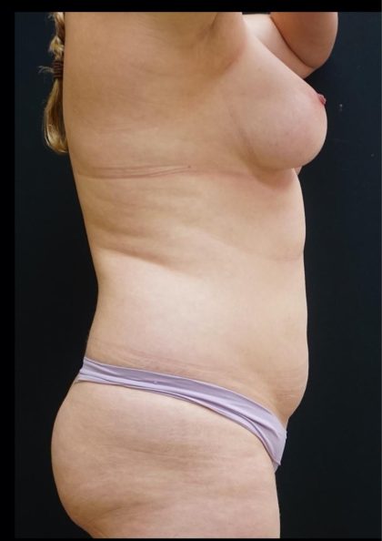 Liposuction Before & After Patient #6942