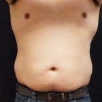Liposuction Before & After Patient #6943