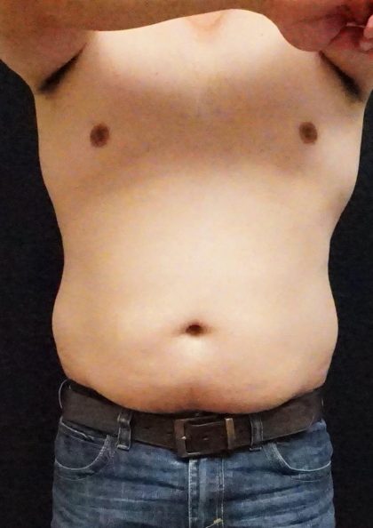 Liposuction Before & After Patient #6943