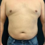 Liposuction Before & After Patient #6943