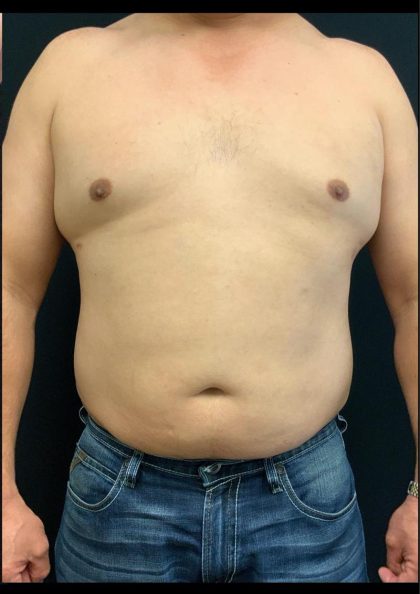 Liposuction Before & After Patient #6943