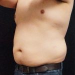 Liposuction Before & After Patient #6943