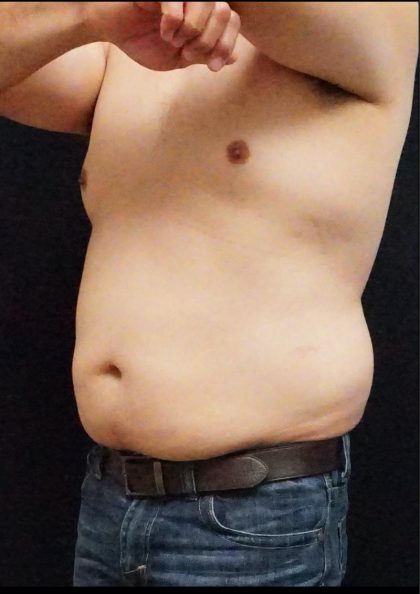 Liposuction Before & After Patient #6943