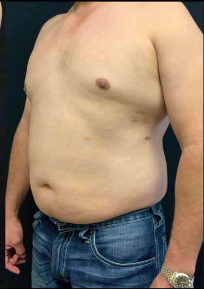 Liposuction Before & After Patient #6943