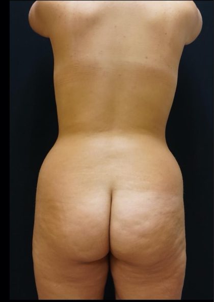 Liposuction Before & After Patient #6944