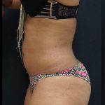 Liposuction Before & After Patient #6945