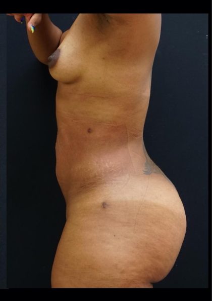 Liposuction Before & After Patient #6945