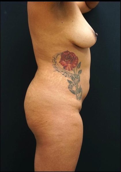 Liposuction Before & After Patient #6946