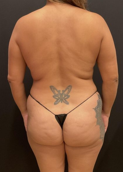 Mommy Makeover Before & After Patient #6693