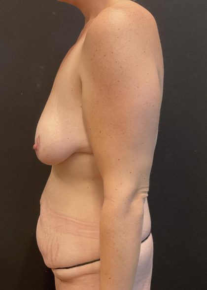 Mommy Makeover Before & After Patient #5939