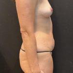 Mommy Makeover Before & After Patient #5942