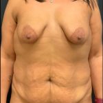Mommy Makover Before & After Patient #5943