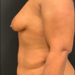 Mommy Makeover Before & After Patient #5943