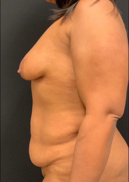 Mommy Makeover Before & After Patient #5943