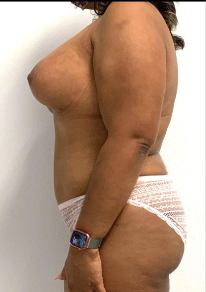 Mommy Makeover Before & After Patient #5943