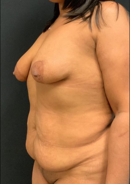 Mommy Makeover Before & After Patient #5943