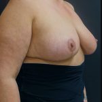 Breast Reduction Before & After Patient #6285