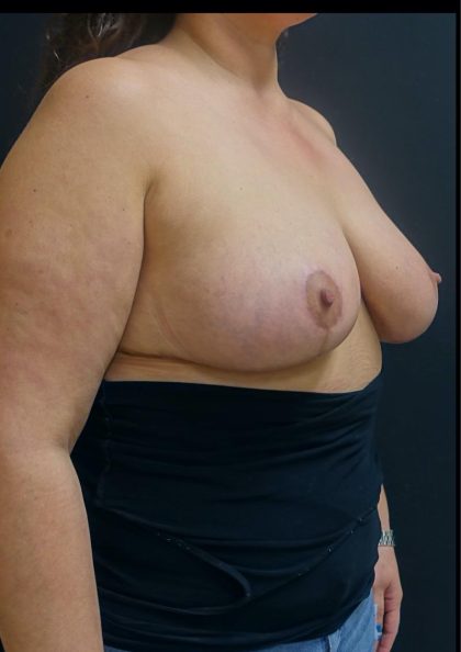 Breast Reduction Before & After Patient #6285