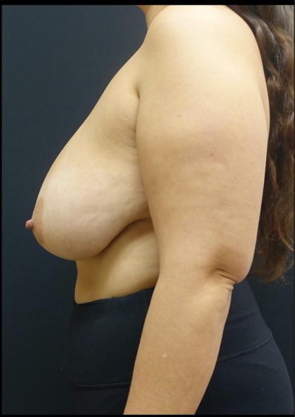 Breast Reduction Before & After Patient #6285