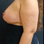 Breast Reduction Before & After Patient #6285