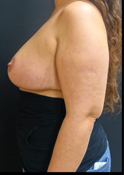 Breast Reduction Before & After Patient #6285