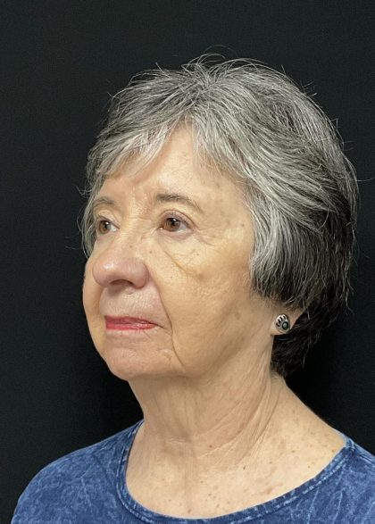 Rhinoplasty Before & After Patient #6700