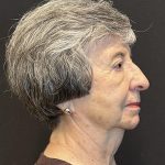 Rhinoplasty Before & After Patient #6700