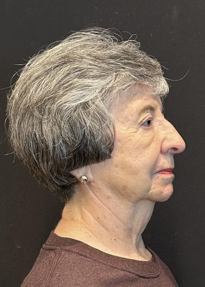 Rhinoplasty Before & After Patient #6700