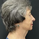 Rhinoplasty Before & After Patient #6700