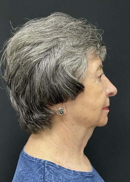 Rhinoplasty Before & After Patient #6700