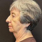 Rhinoplasty Before & After Patient #6700