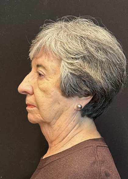 Rhinoplasty Before & After Patient #6700
