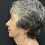 Rhinoplasty Before & After Patient #6700
