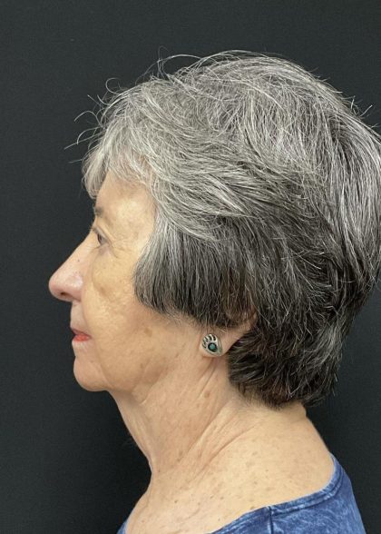 Rhinoplasty Before & After Patient #6700