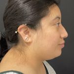Rhinoplasty Before & After Patient #6698