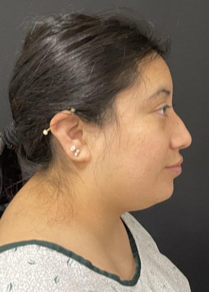 Rhinoplasty Before & After Patient #6698