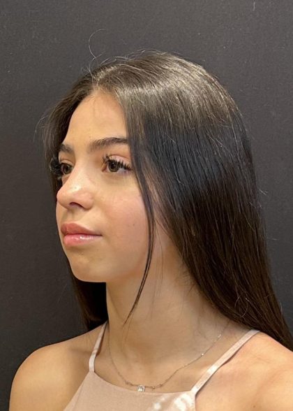 Rhinoplasty Before & After Patient #6699