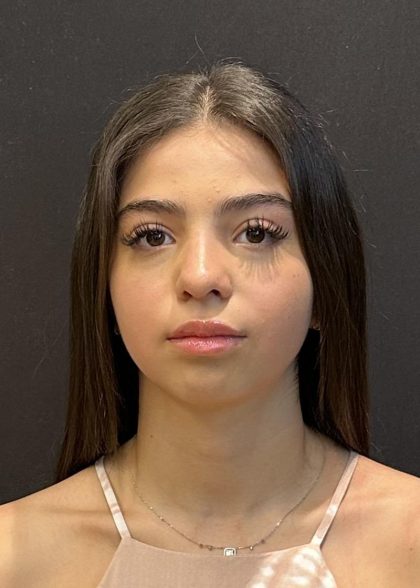 Rhinoplasty Before & After Patient #6699