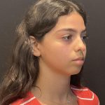 Rhinoplasty Before & After Patient #6699
