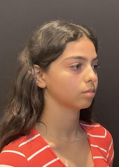 Rhinoplasty Before & After Patient #6699