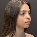 Rhinoplasty Before & After Patient #6699