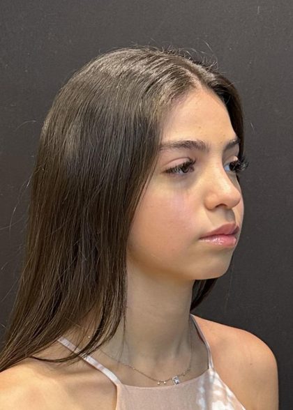 Rhinoplasty Before & After Patient #6699