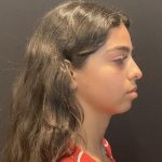 Rhinoplasty Before & After Patient #6699