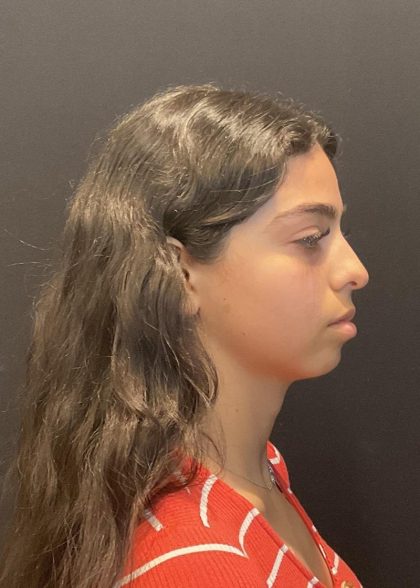 Rhinoplasty Before & After Patient #6699