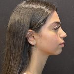 Rhinoplasty Before & After Patient #6699